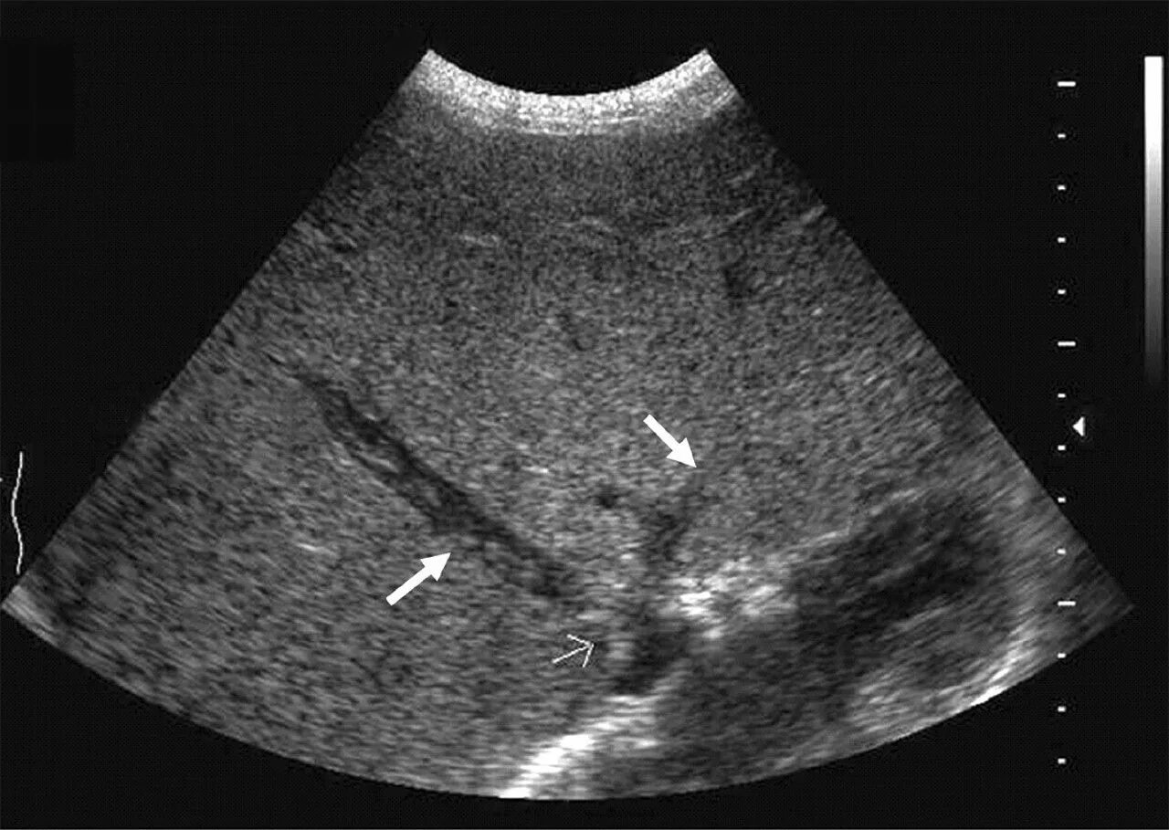 Синдром Бада киаори УЗИ. Синдром БАДАКИАРИ на УЗИ. Синдром Бадда Киари на УЗИ. Тромбоз вен печени