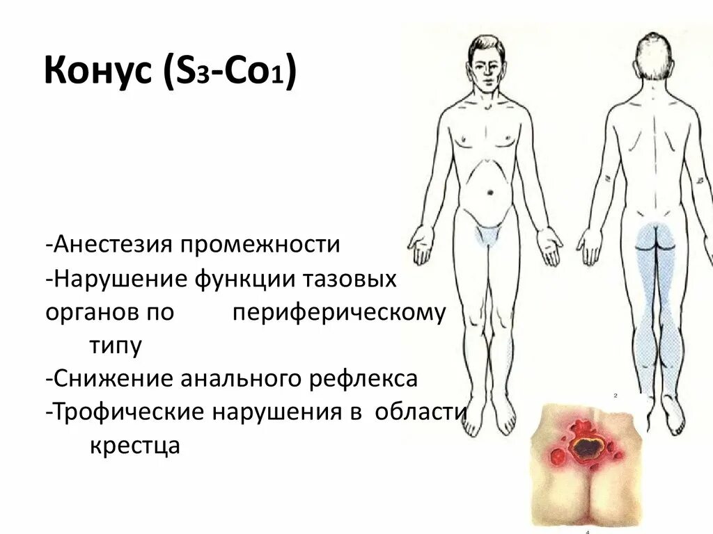 Нарушение тазовых органов по периферическому типу