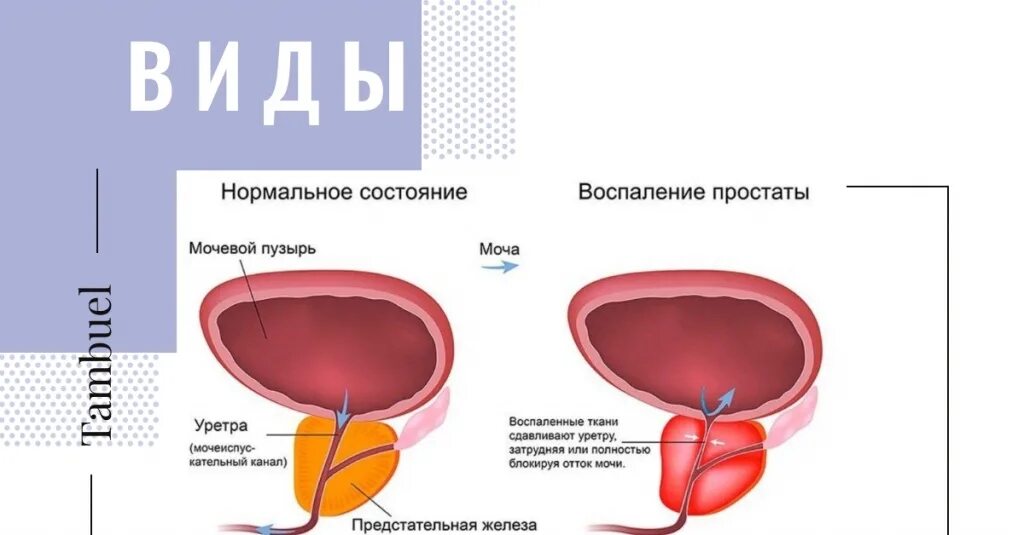 Состояния простаты