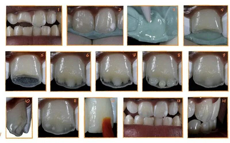 Микропротезы виниры вкладки стоматология. Зубы клиновидный кариес. Восстановление передних зубов. Материал для реставрации зубов