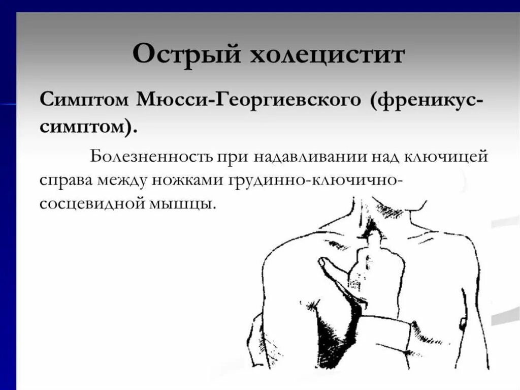 Пальпация при остром животе. Симптом Мюссе холецистит. Острый холецистит симптом Мюсси. Симптом Мюсси-Георгиевского. Симптомы Кера, Ортнера, Мюсси Георгиевского.