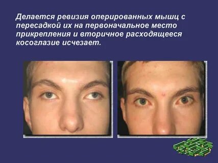 Исправление косоглазия у взрослых операция