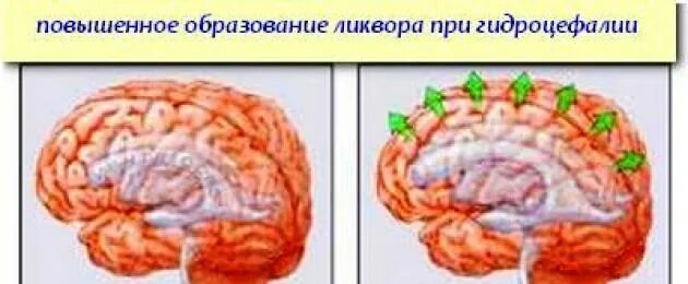 Гипертензионный синдром головного мозга. Строение головного мозга человека желудочки. Мозг человека строение гидроцефалией. Расширение желудочков головного мозга. Расширение желудочков дети