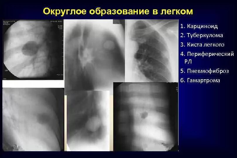 Туберкулома рентген. Округлое образование в легком. Округлых образования в лёгких. Образование в легких что это может быть