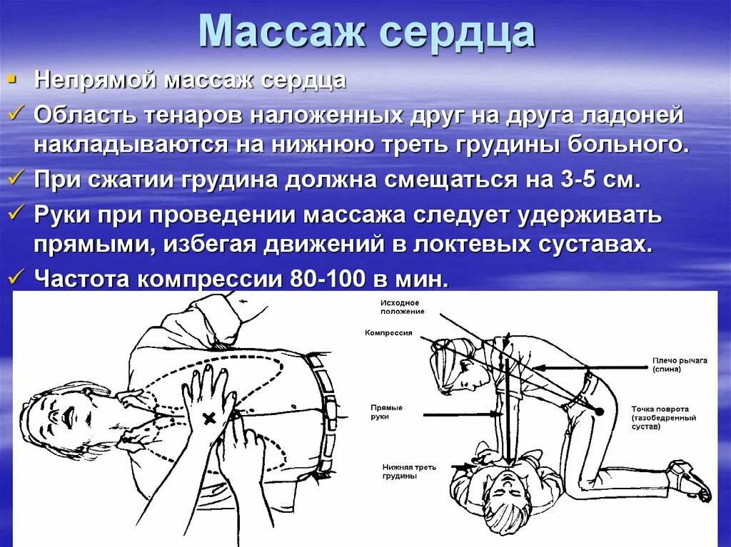 При проведении непрямого массажа сердца. Наружный непрямой массаж сердца. При проведении закрытого массажа сердца. Компрессия грудной клетки при непрямом массаже сердца