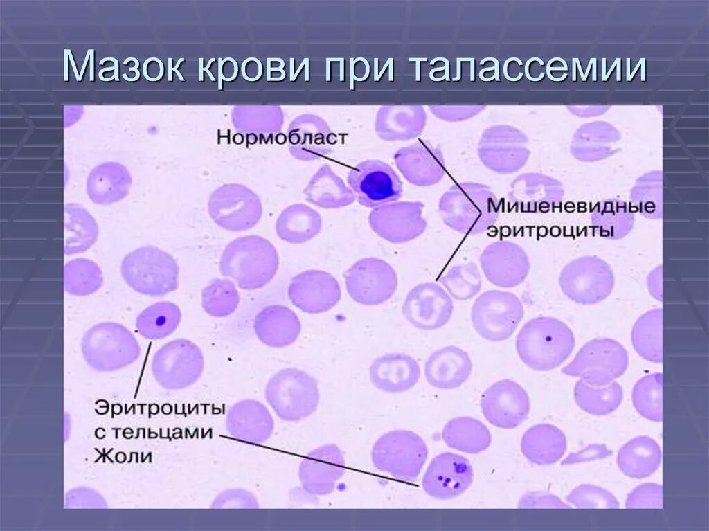 Мазок крови при выявлении патологии что это. Талассемия картина крови гистология. Гемолитическая анемия мазок крови. Морфология эритроцитов при гемолитической анемии. Талассемия морфология эритроцитов.