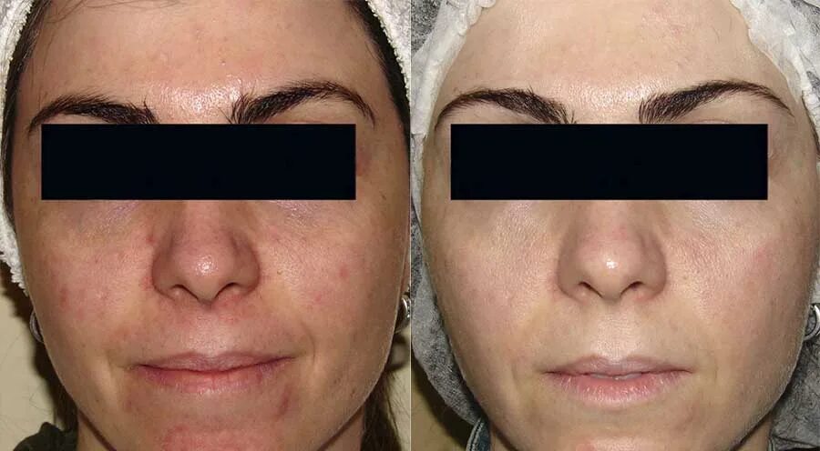 Фототерапия м22. Ipl фототерапии отзывы. Ipl фототерапии отзывы. Ipl фототерапии отзывы. Фотоомоложение лица ipl lumecca.