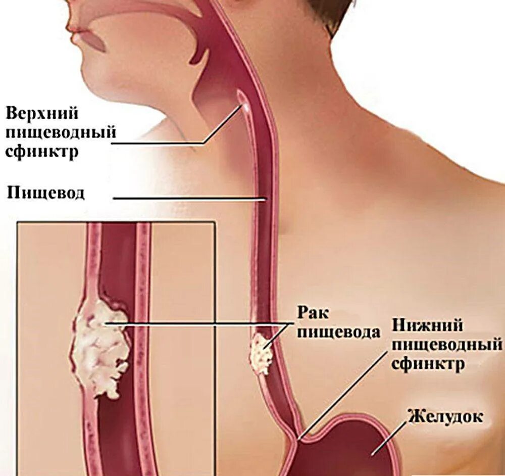 Пищевод боль в спине. Новообразования гортани. Объемное образование пищевода.
