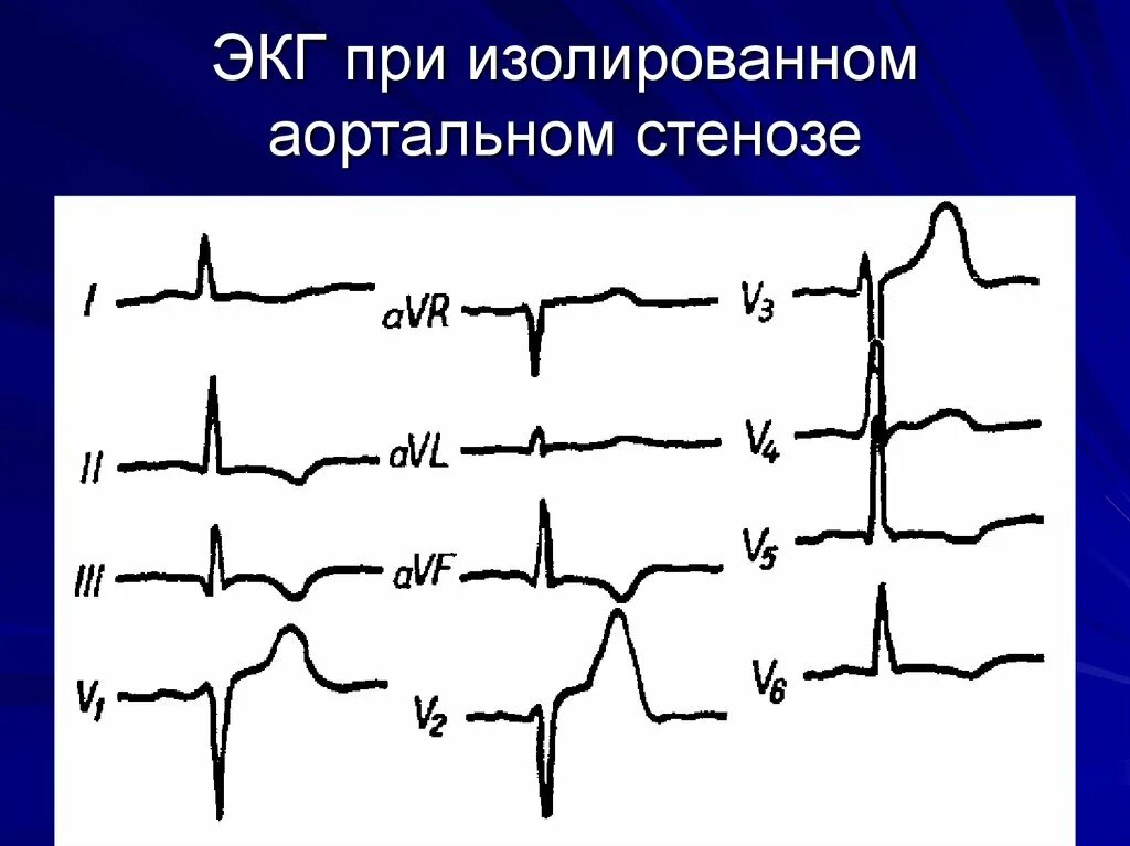 Показывает ли экг сердечную недостаточность. Аортальная недостаточность экг. аортальный стеноз экг. экг признаки при пороках аортального клапана. аортальный стеноз экг признаки.