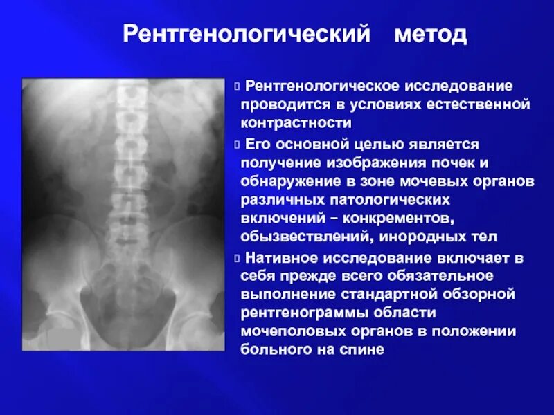 Методы лучевой диагностики мочевыделительной системы. Рентгенологические методы мочевыделительной системы. Рентген почек обзорная урография. Экскреторная урография контраст. Линейная томография почек.