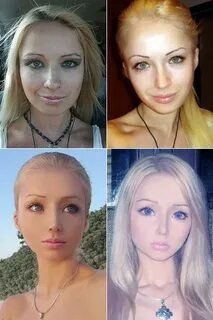 Удаленные нижние ребра