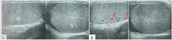 Увеличено яичко у мальчика. Перекрут левого яичка УЗИ. Гидатида яичка на УЗИ У мужчин.