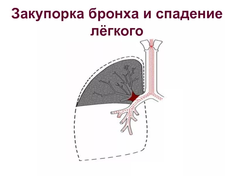 Спадение бронха. Закупорка главного бронха. бронхиальную закупорку.