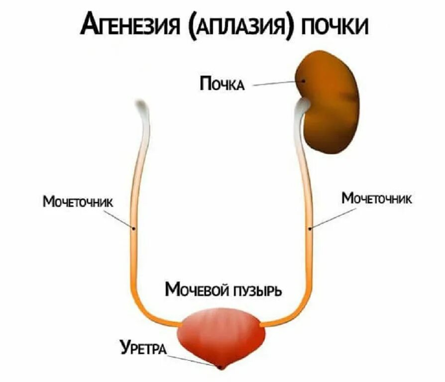 Два мочеточника. Агенезия и аплазия почки. Односторонняя агенезия почек. Врожденная аплазия почки.