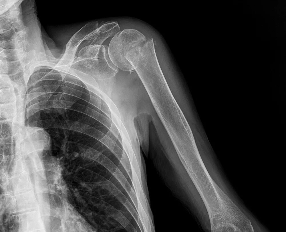 Аддукционный перелом шейки плечевой кости рентген. Перелом плечевой кости рентген. Аддукционный перелом плечевой кости рентген. Перелом плечевого сустава рентген.
