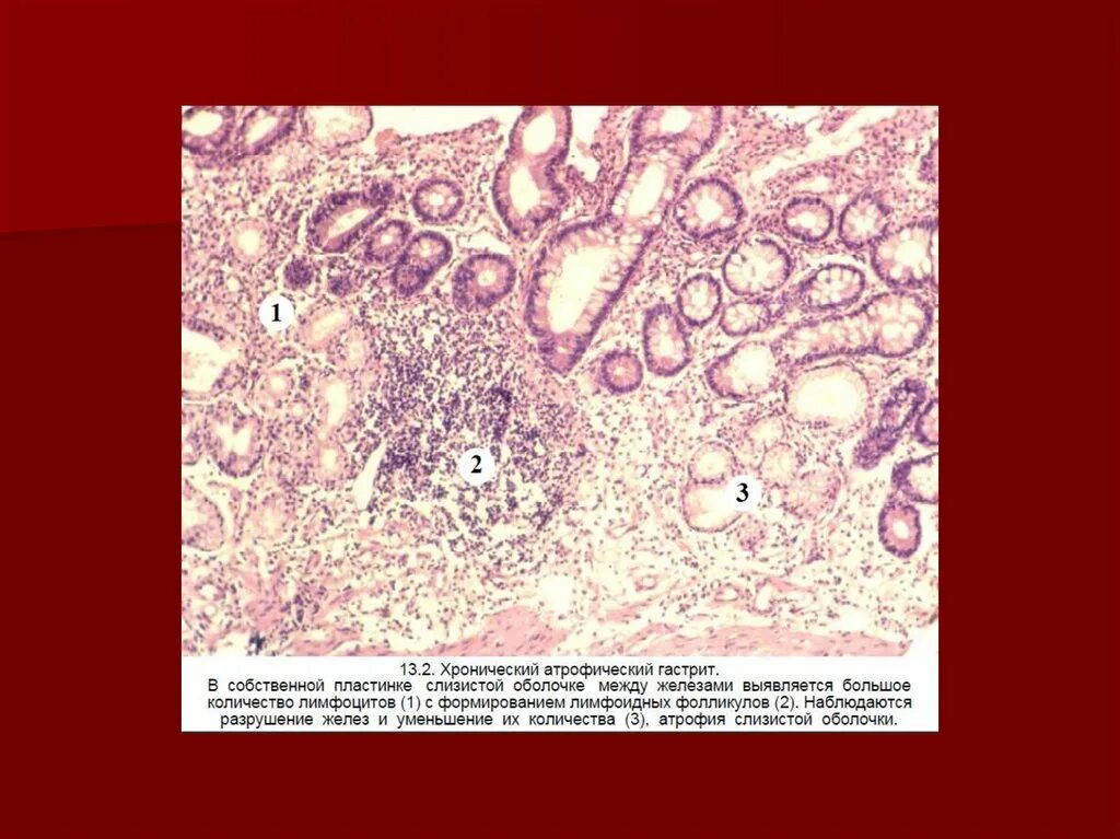 Эрозивный гастрит микропрепарат. Хронический атрофический гастрит патанатомия. Хронический поверхностный гастрит микропрепарат. Хронический поверхностный гастрит патанатомия. Слизистая атрофична