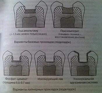 Прокладки при кариесе