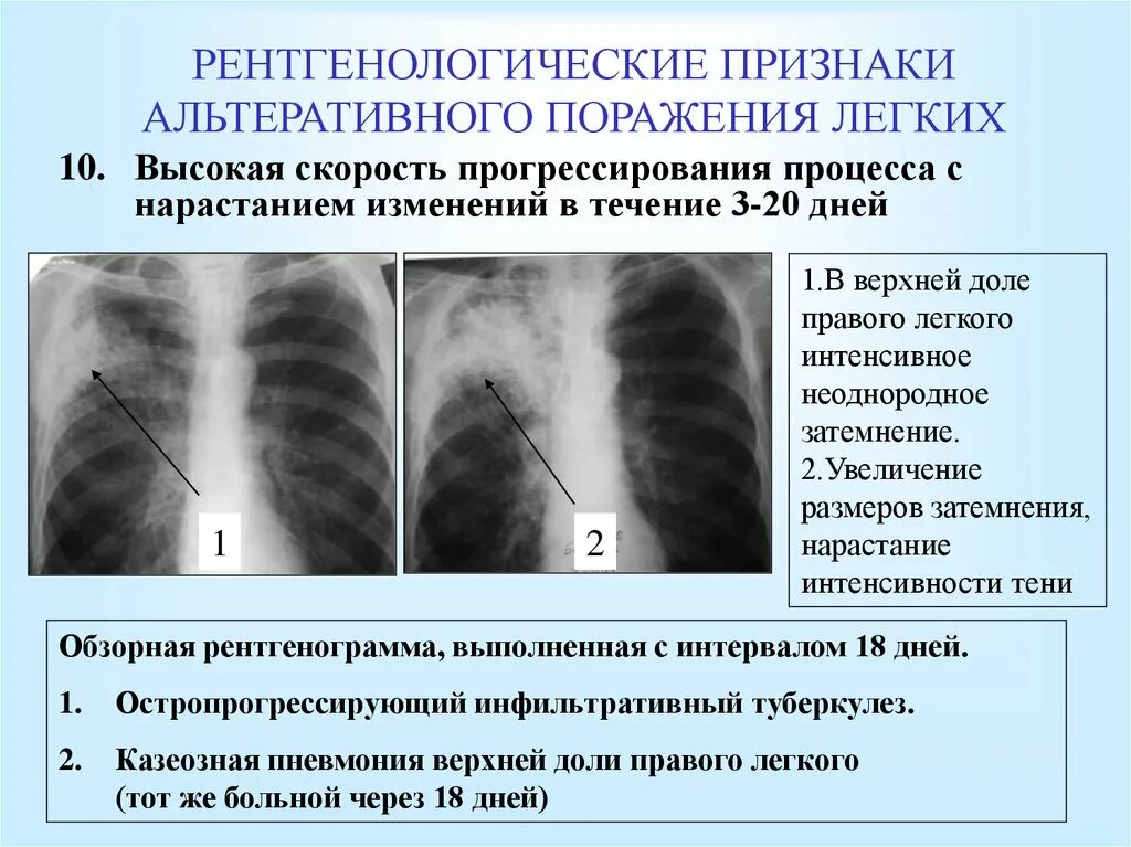 Инфильтративная пневмония рентген. Инфильтративный туберкулез рентген. Инфильтративный туберкулёз рентген симптомы. Рентген при внебольничной пневмонии.