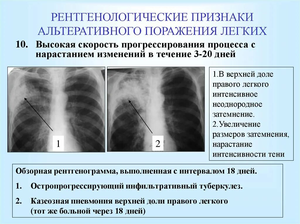 Что означает изменения в легких. Инфильтративная пневмония рентген. Инфильтративный туберкулез рентген. Инфильтративный туберкулёз рентген симптомы. Рентген при внебольничной пневмонии.