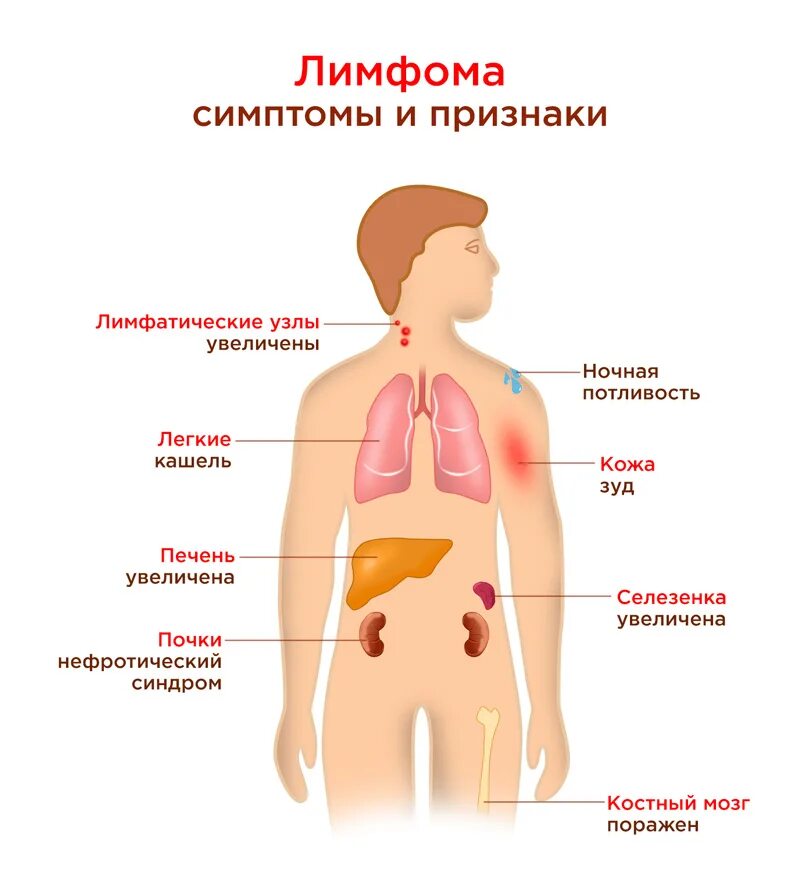 Причина заболевания лимфомой. В-симптомы при лимфоме Ходжкина. Характерные симптомы лимфомы.