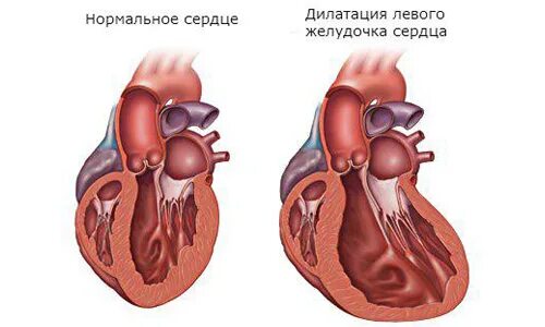 Дилатация левого желудочка. Расширение камер сердца. Дилатация камер сердца. Дилатация полостей предсердий