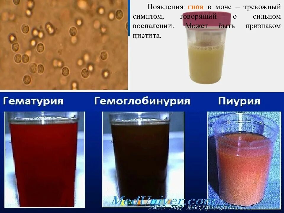 Осадок в моче. Гематурия пиурия. Осадок в моче после отстаивания. Розовый осадок в моче у мужчин.