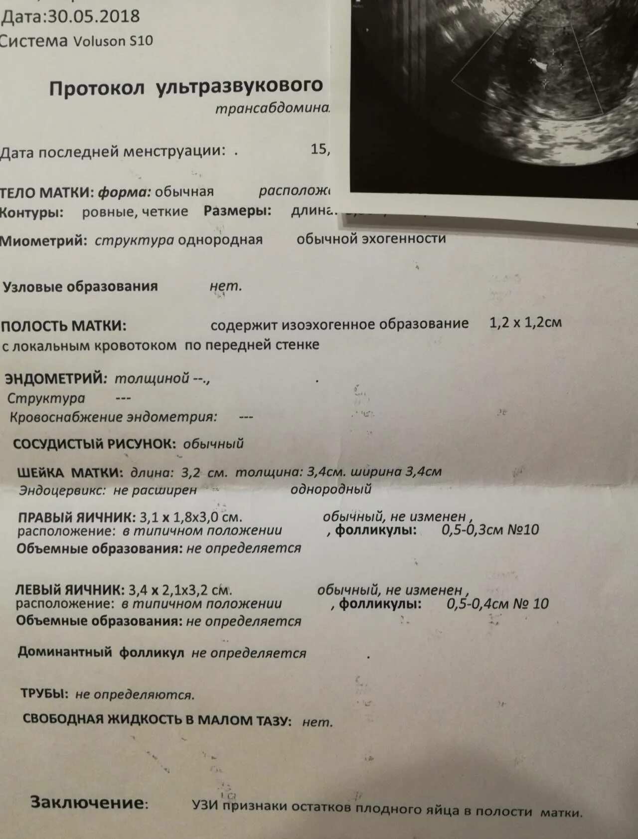 Может ли узи показать неправильно. Узи после медикаментозного прерывания беременности заключение. протокол узи неполный выкидыш. протокол узи после медикаментозного аборта. узи малого таза после медикаментозного прерывания беременности.