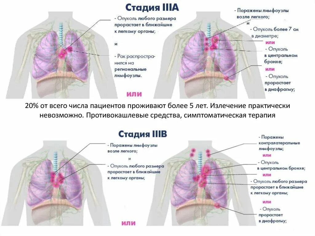 Рак легкого симптомы сколько живут. Раковая опухоль легкого. Центральная опухоль легкого.