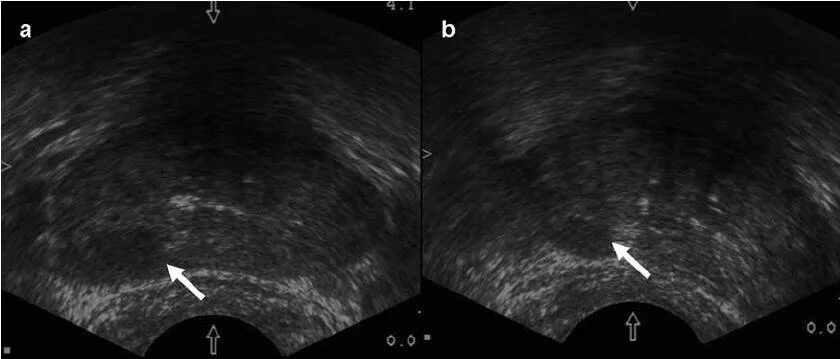 Трузи предстательной железы подготовка к исследованию. УЗИ трузи предстательной железы. Предстательная железа на УЗИ трансректально норма. Парауретральный фиброз УЗИ\.