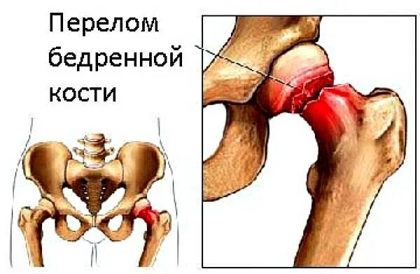 Перелом шейки бедра в пожилом возрасте. Бедренная кость перелом шейки. Остеопороз шейки бедренной кости. Остеопороз перелом шейки бедра. Шейка тазобедренного сустава перелом.
