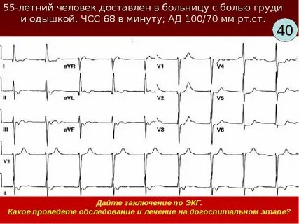 Состояние экг