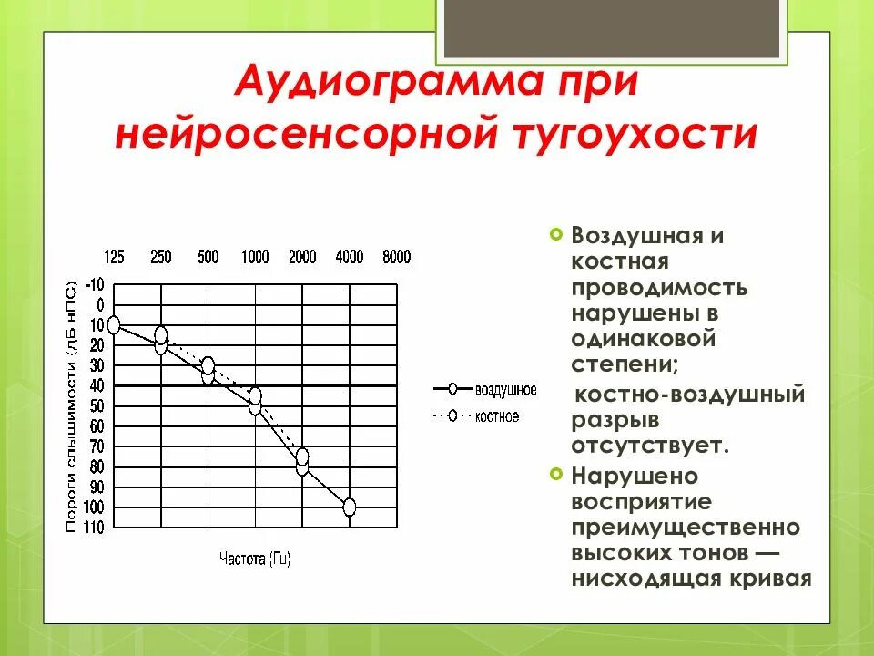 Аудиограмма ребенку. Аудиограмма 2 степени тугоухости. Аудиограмма 2 степени нейросенсорной тугоухости. Аудиограмма при тугоухости 2 степени. Кондуктивная тугоухость аудиометрия.