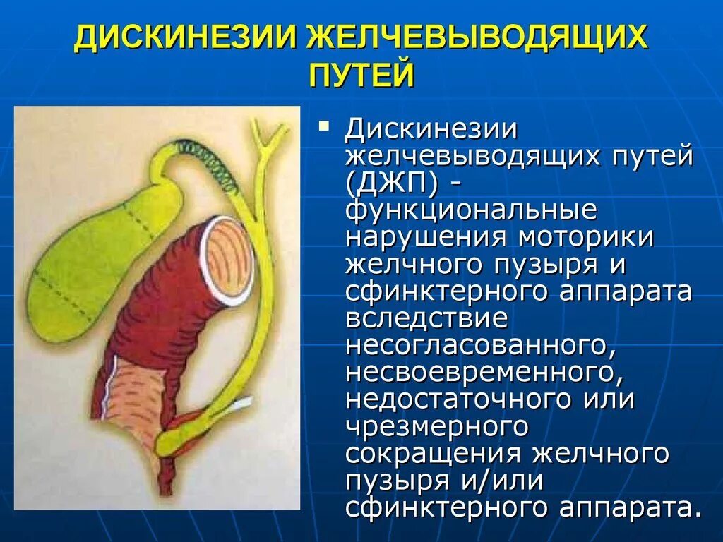 Нарушение функций желчевыводящих путей. Заболевание дискинезия желчевыводящих путей. Синдром дискинезии желчевыводящих путей. Дискинезия желчевыводящих путей симптомы. Нарушение желчеоттока