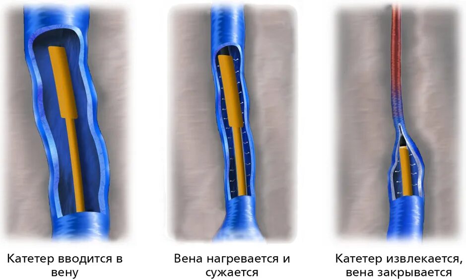 Эндовазальная термическая облитерация. Эндовенозная лазерная облитерация вен. Радиочастотная облитерация варикозных вен. Эндовазальная радиочастотная абляция. Удаление тромба цена