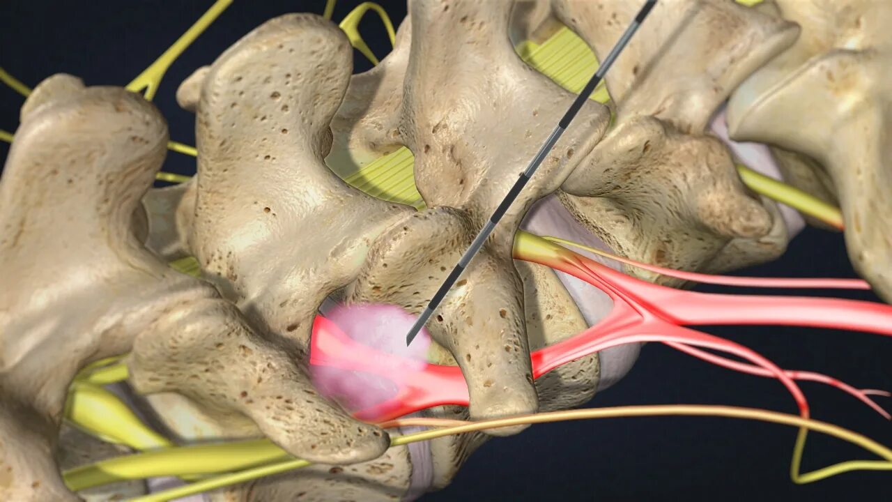 Седалищный нерв грыжа позвоночника. Межпозвоночная грыжа седалищного нерва. Трансфораминальная блокада.