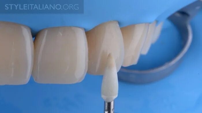 Винир прямой композитный. Адгезивный протокол фиксации виниров. лампа для засвечивания пломб. засвечивание реставрации.