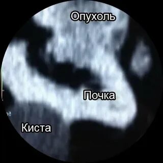 Синусные кисты обеих