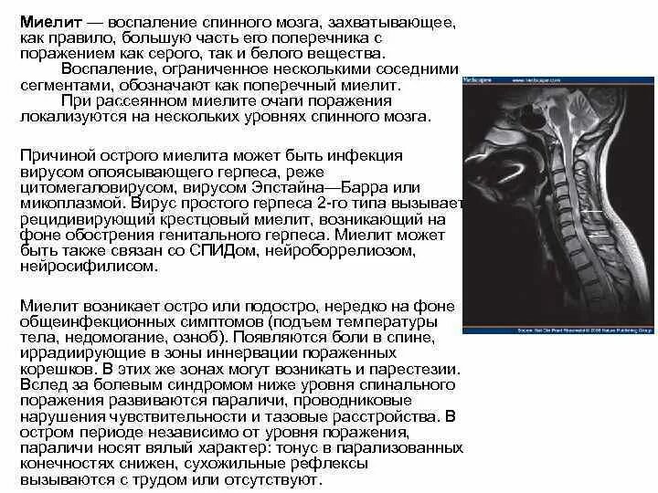 Боль в спинном мозге. Острый поперечный миелит спинного мозга мрт. Поперечный миелит схема. Миелит грудного отдела позвоночника. Поперечный миелит мрт.