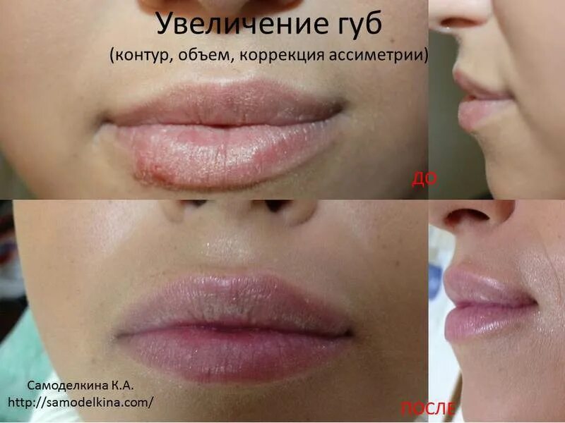 Увеличение губ до и после отзывы. Juvederm 1 мл увеличение губ. Увеличение губ по контуру. Увеличение губ до и после.