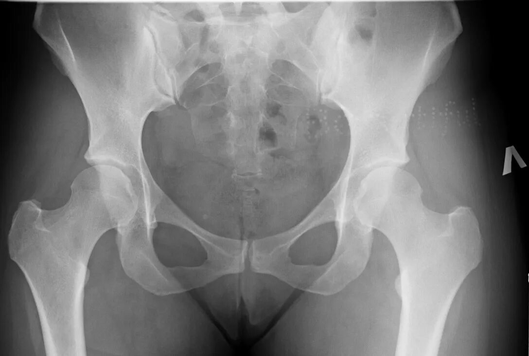 Саблевидная лобковая кость рентген. Перелом подвздошной кости таза рентген. Перелом крестца рентген. Перелом костей таза рентген.
