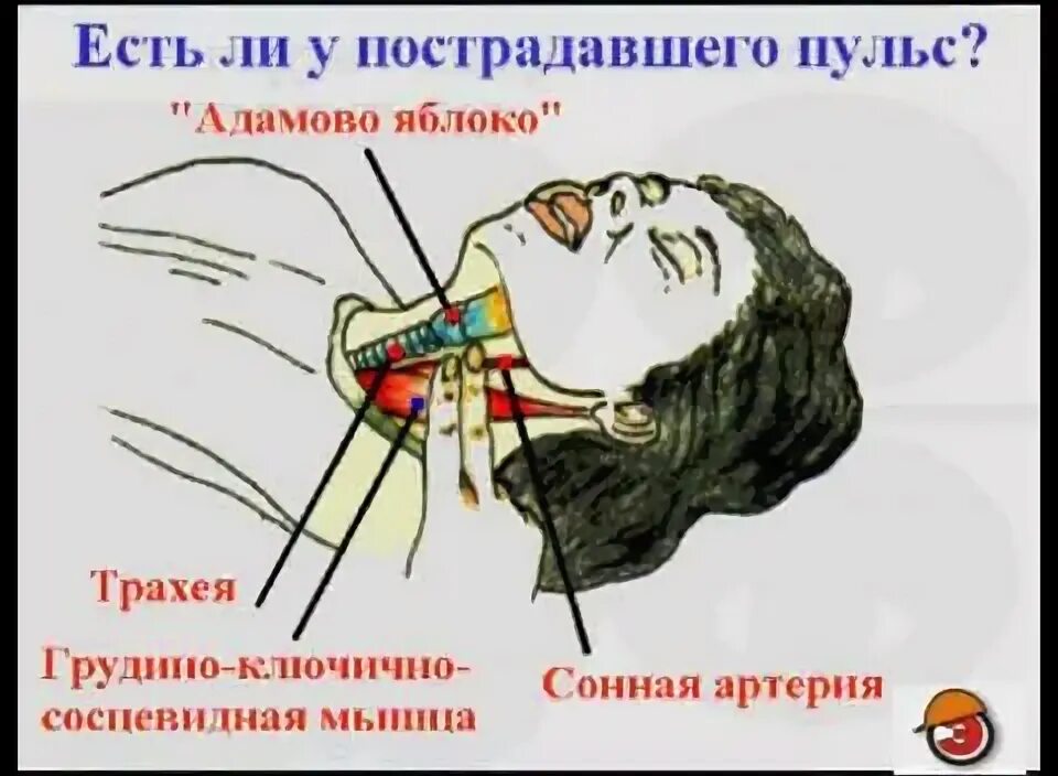 Сонная артерия через сколько умирает. Диссекция внутренней сонной артерии. Где находится сонная ар;ерия. Сонная артерия и яремная вена. Сонная артерия через сколько умирает.