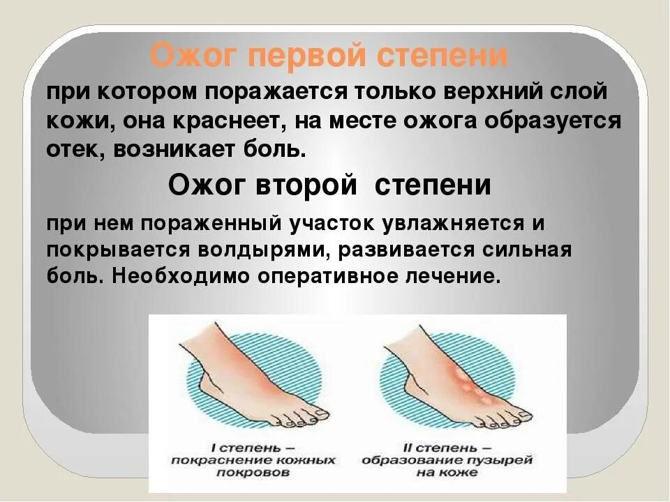 Как облегчить боль при ожоге