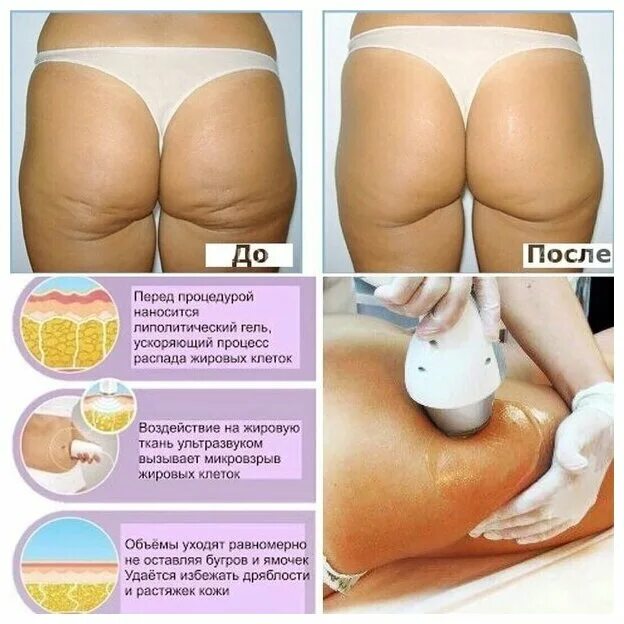 Ультразвуковая кавитация схема. Низкочастотная ультразвуковая кавитация. Аппарат для похудения. Кавитация тела. Ультразвуковая кавитация описание.