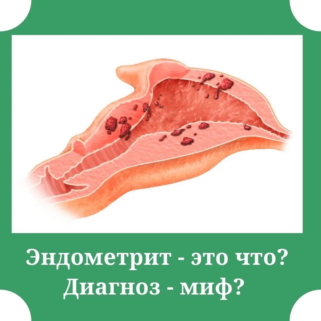 Эндометрит параметрит метроэндометрит. Послеродовый параметрит. Послеродовой миометрит. Хронический эндометрий. Лохиометра это