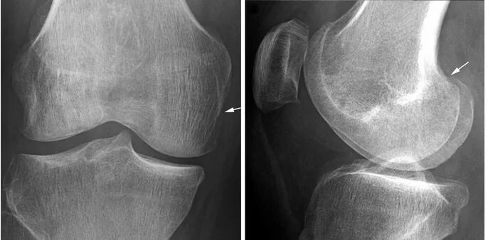 Краевой перелом мыщелка бедренной кости. Краевой перелом надколенника. Перелом внутреннего мыщелка бедренной кости. Перелом мыщелка рентген.
