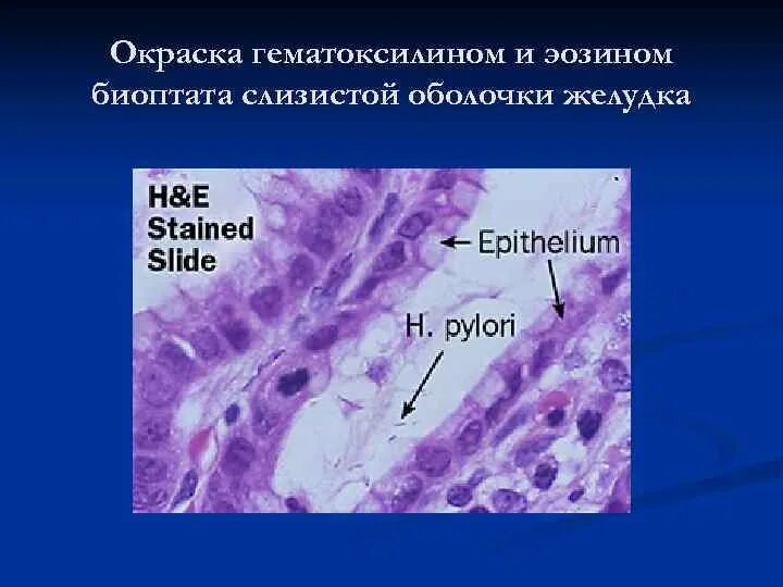 Окраска гематоксилином и эозином. Хеликобактер гематоксилин эозин. Биоптат слизистой оболочки желудка что это такое. Хеликобактер пилори в биоптате. Биоптат слизистой оболочки