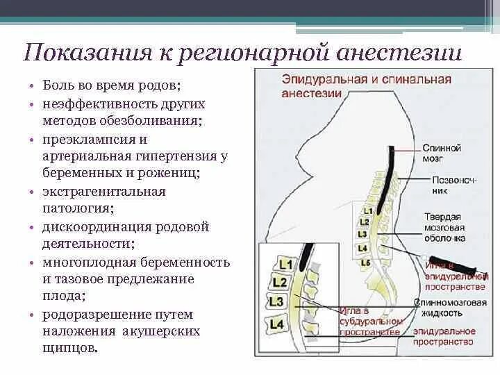 Эпидуральная спинная. Субдуральная эпидуральная перидуральная анестезия. Инфильтрационная эпидуральная анестезия. Показания для проведения эпидуральной и спинномозговой анестезии. Спинальная анестезия показания.