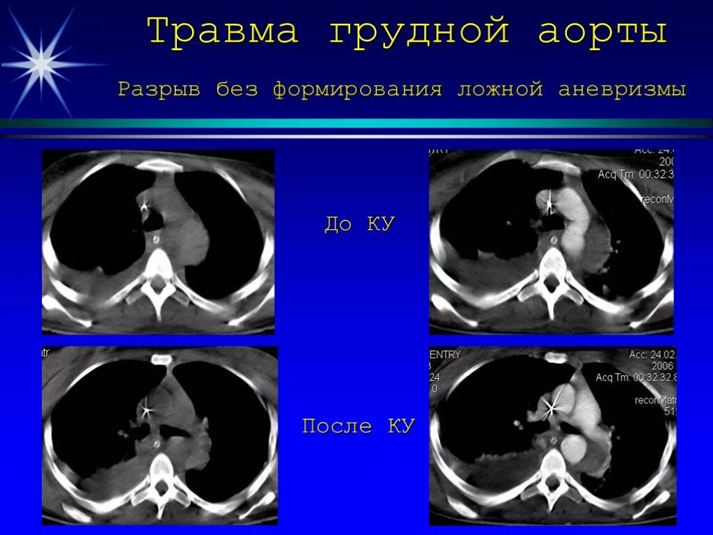 От чего бывает разрыв аорты. Разрыв грудной аорты кт. расслаивающая аневризма аорты кт.