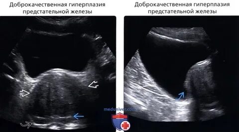 Трансабдоминальное предстательной железы
