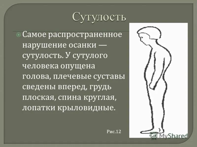 Прямая спина. Осанка. Голова выдвинута вперед. Нарушение осанки круглая спина. Человек сутулится.